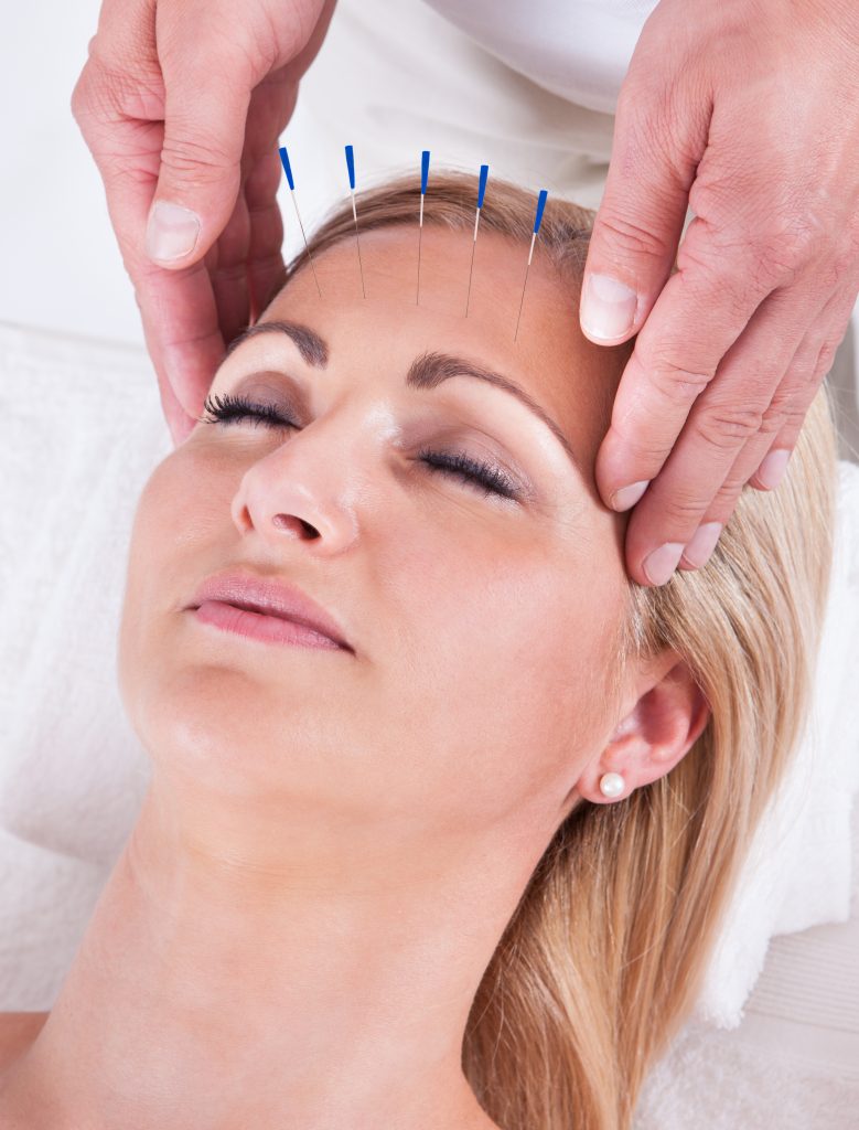 Women receiving acupuncture
